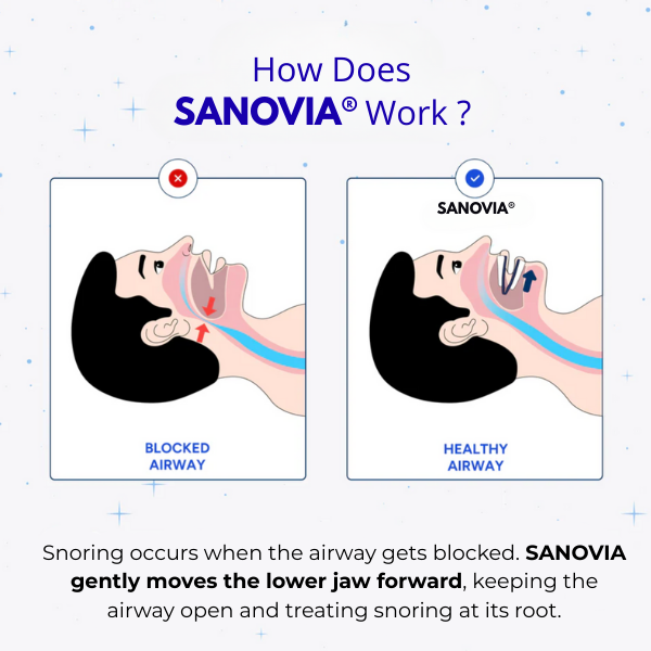 Anti-Snoring Mouthpiece Sanovia®